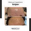 SkinTra - Sniper - Krem na Niedoskonałości - 20ml 
